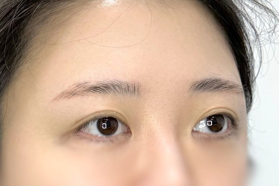 울상 눈썹 시술 전
