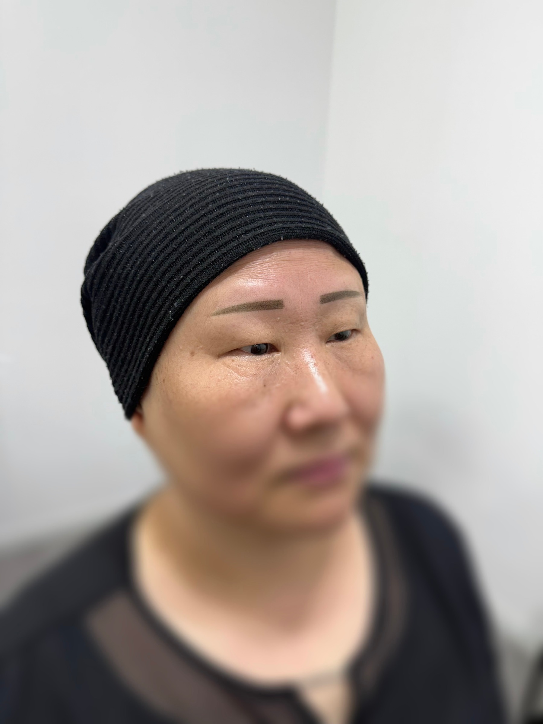 시술 전