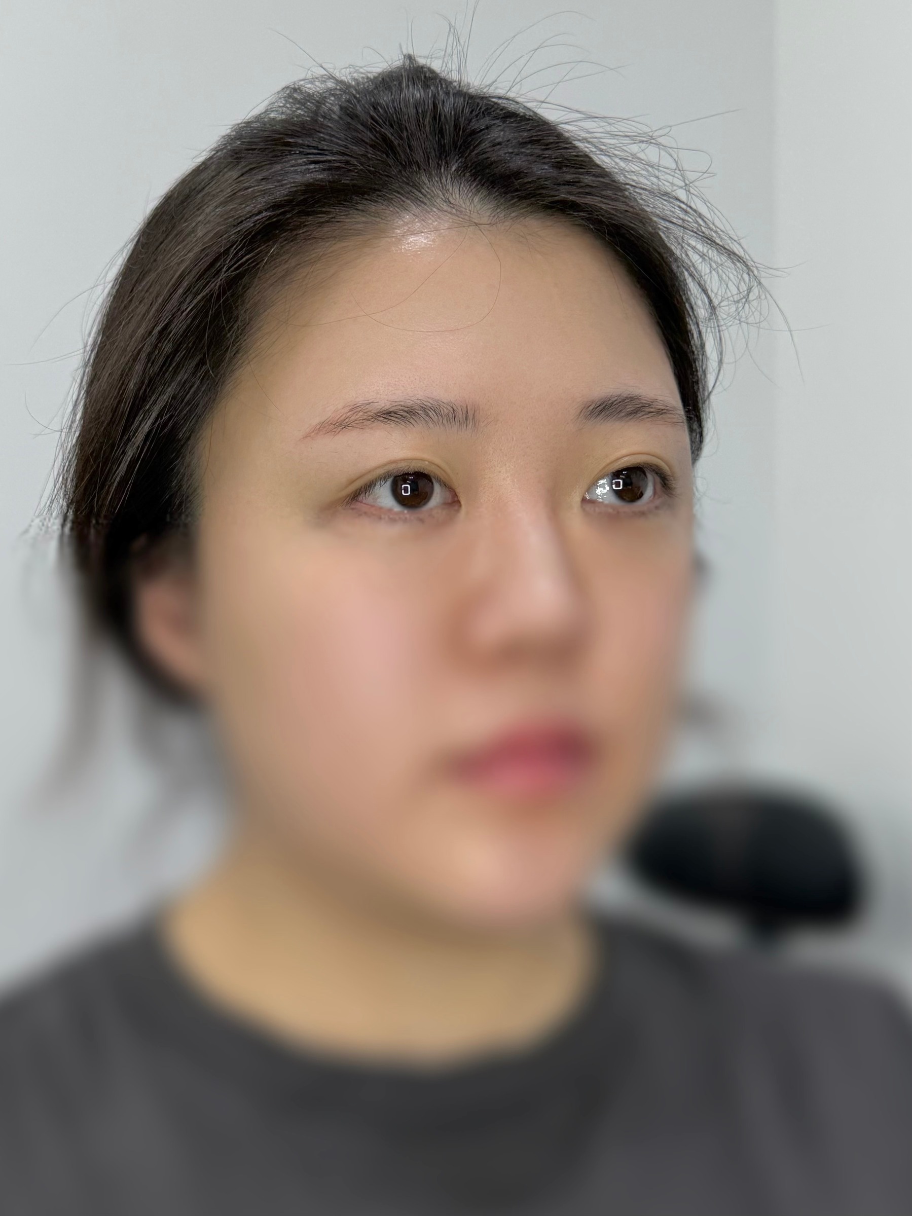 시술 전