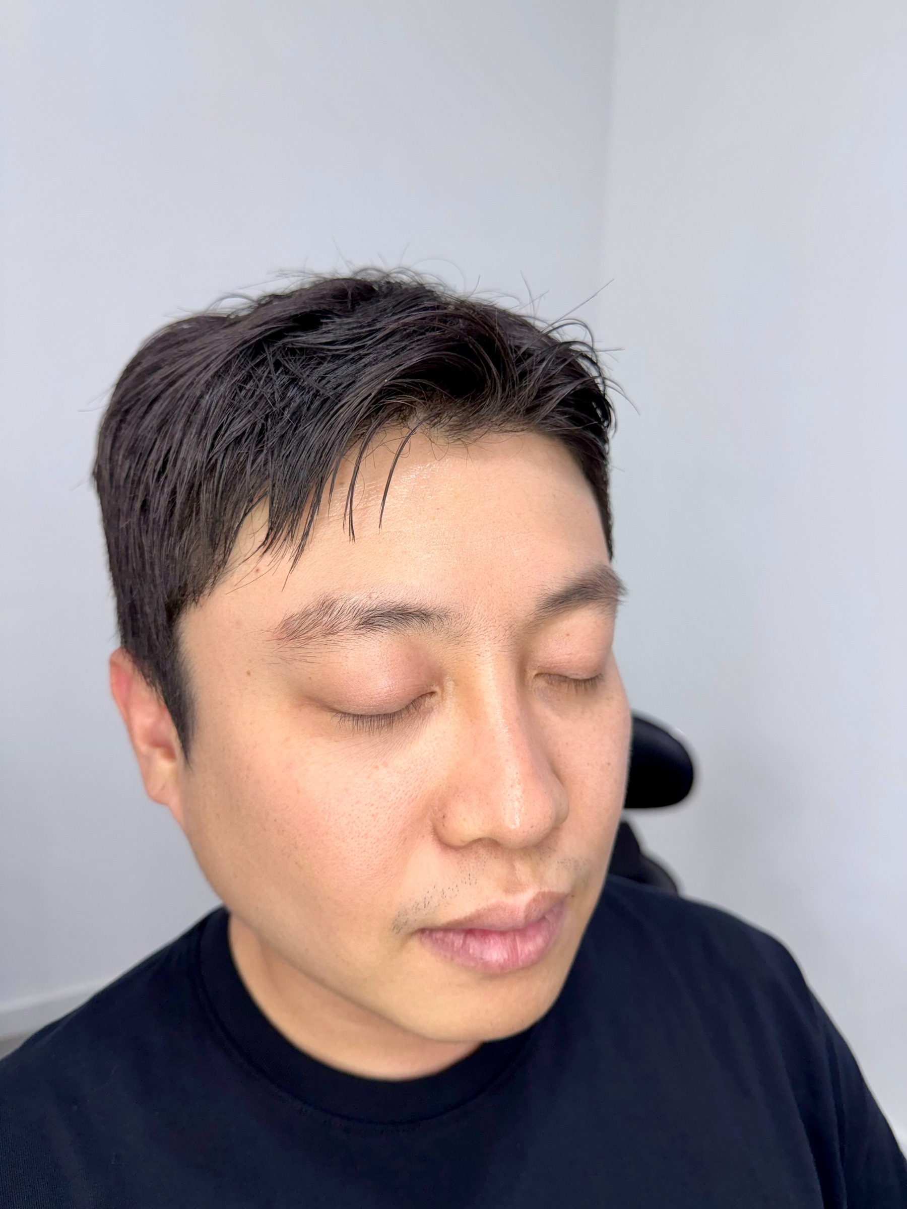 시술 전